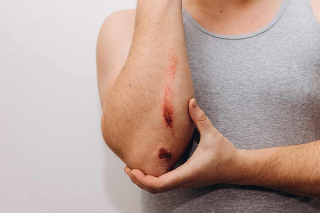 what to do when a dog bites you