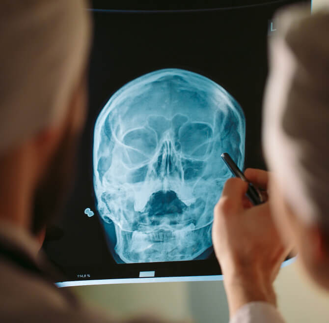 traumatic brain injury on x-ray.